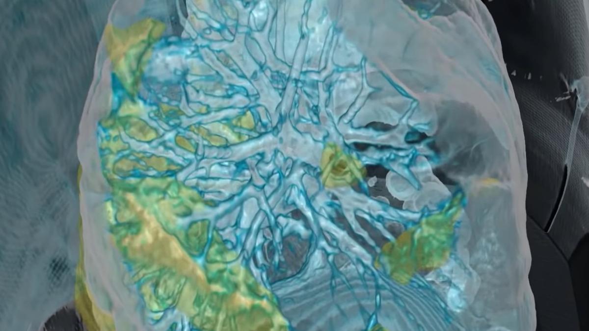 plamani_bbc_pacient_infectat_scanare_3d_01129900