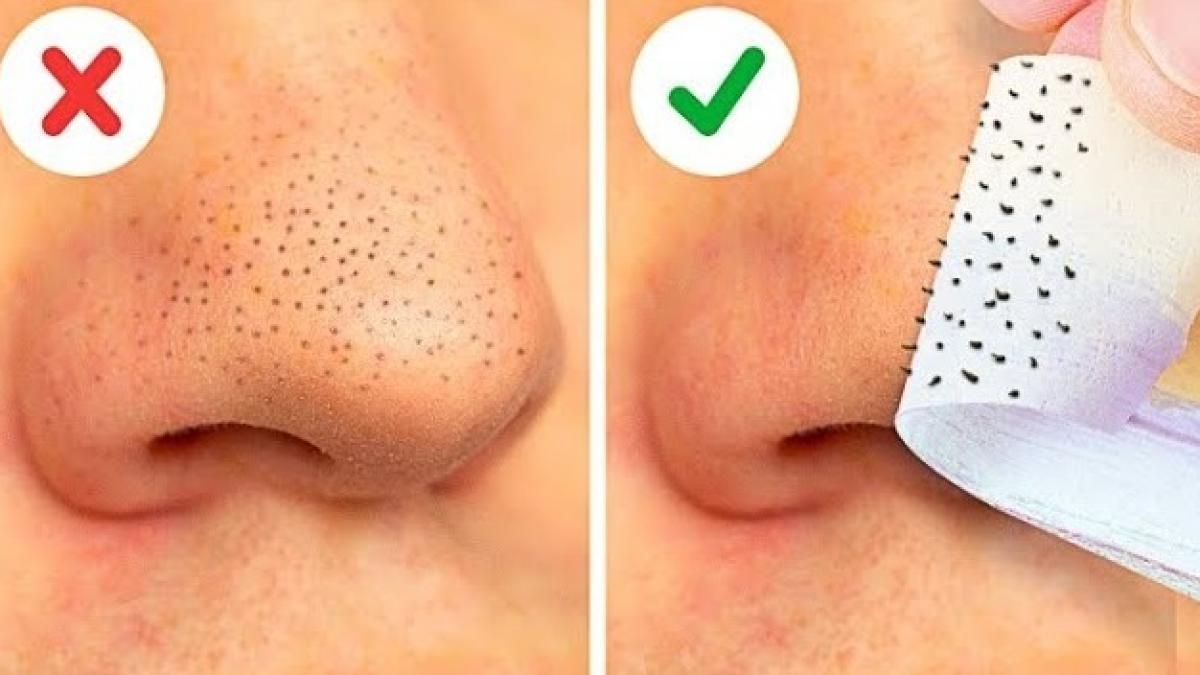 cum-scapi-rapid-de-punctele-negre--peste-20-de-moduri-simple-si-rapide-video_25578500