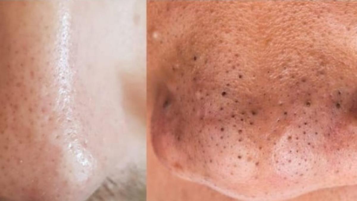 filamente-seboreice-vs--puncte-negre-ce-sunt-si-care-e-diferenta-dintre-ele_17478500