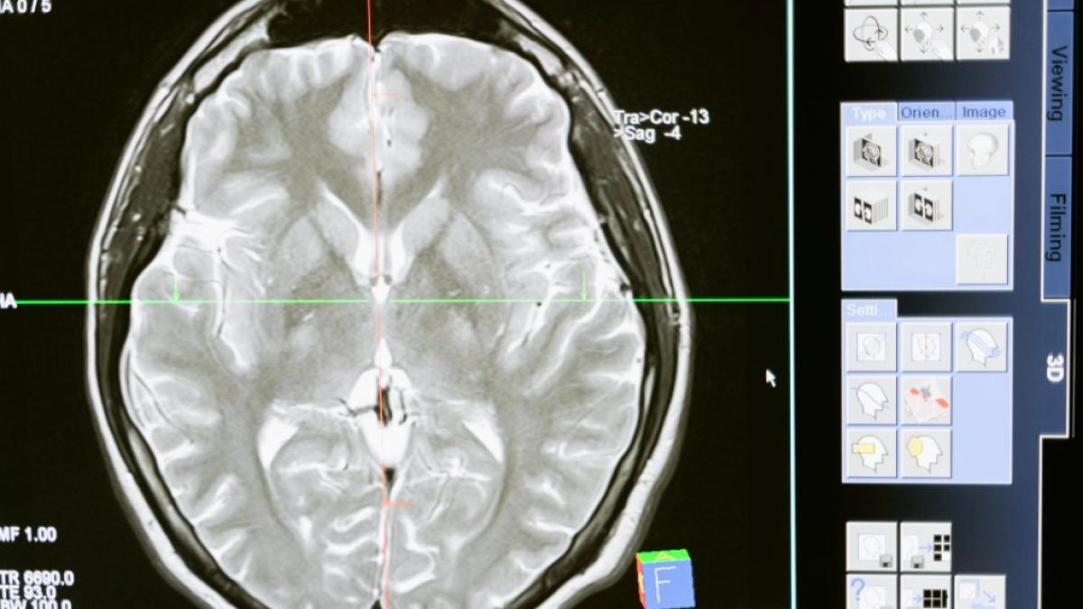 tumoare_cerebrala_ilustrativ_pexels_international_03669600