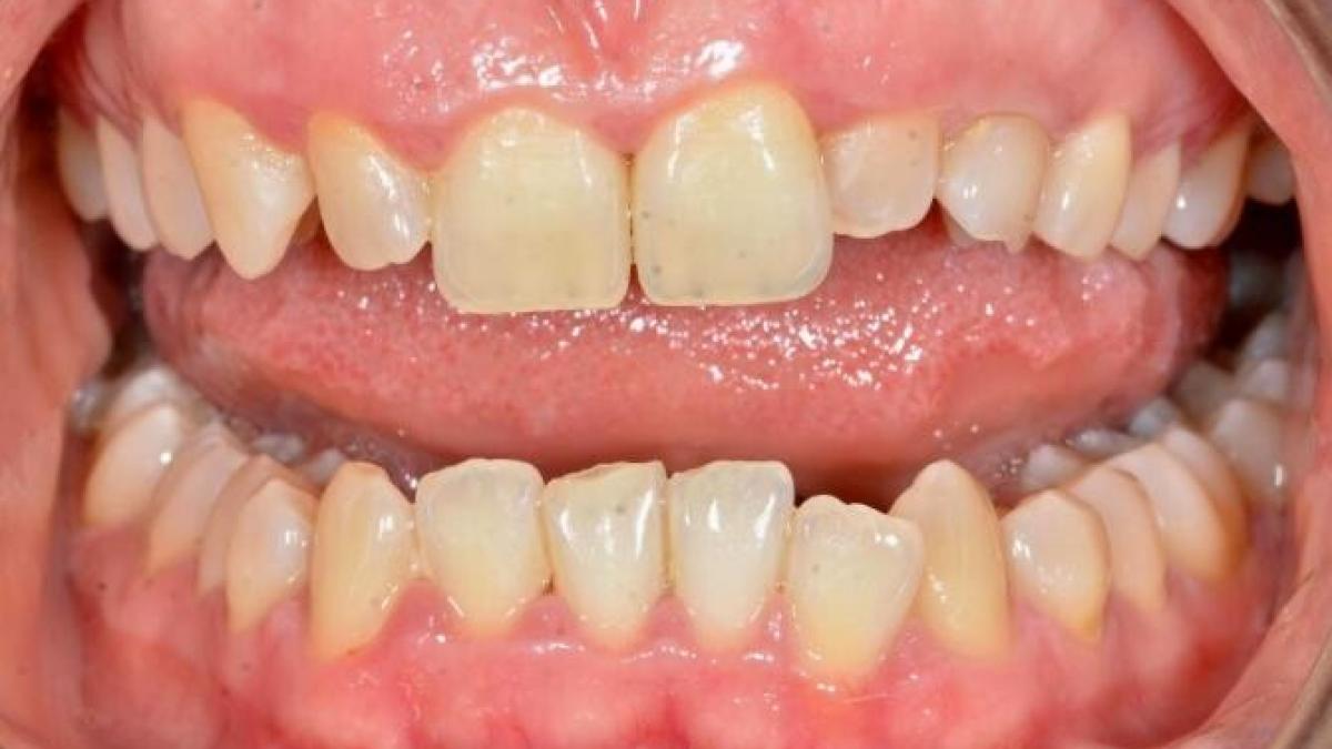 implant-dentar_56846000