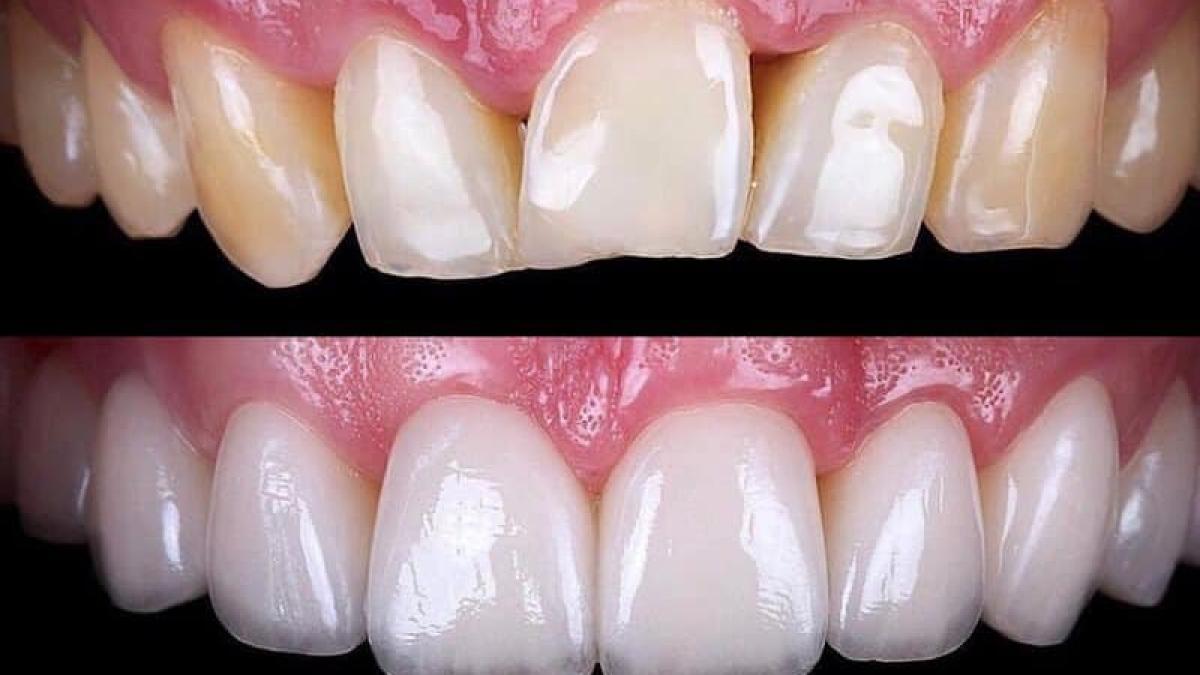 albire-dentara-denisa-zaharia_01960700