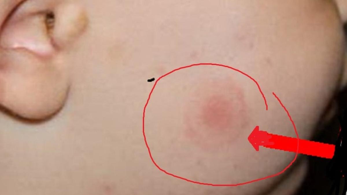 10-lucruri-bine-de-stiu-despre-muscatura-de-capusa--tudor-ciuhodaru-atentioneaza-boala-cu-1000-de-fete_86160700