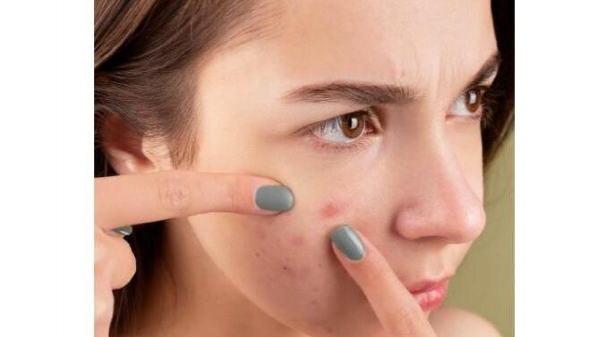 medicul_vasi_radulescu_despre_acnee_foto_pexels_43844300