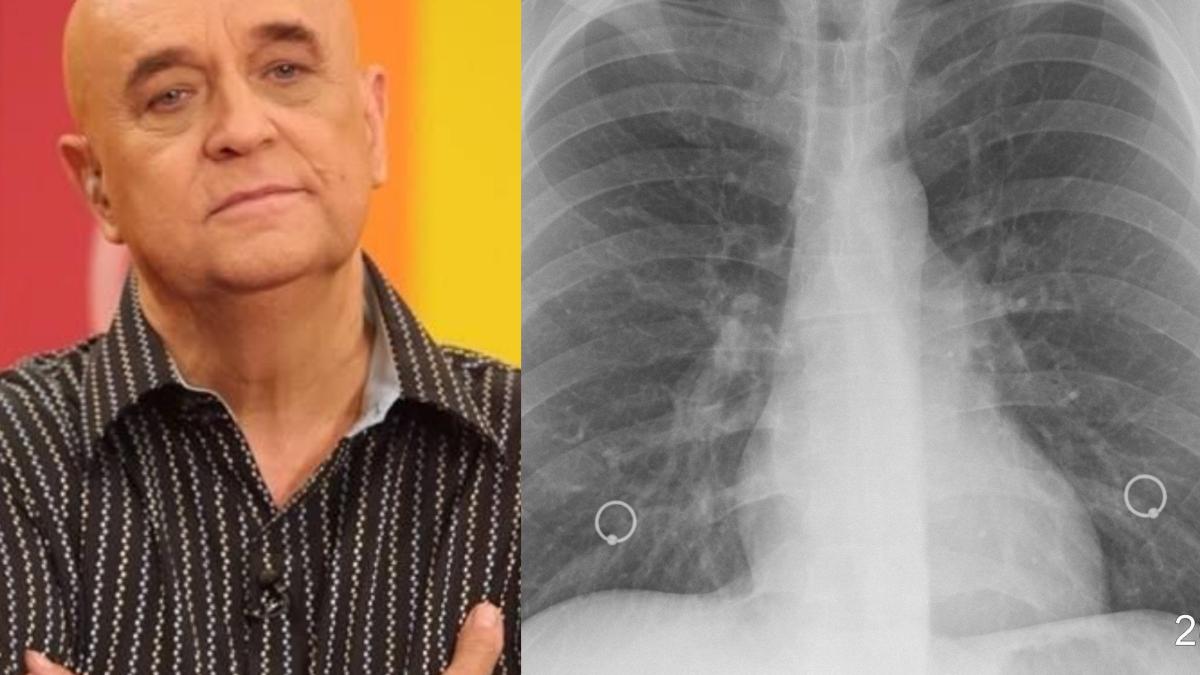 ce-este-pneumonia-de-aspiratie--boala-care-l-a-ucis-pe-benone-sinulescu--atentie--cu-totii-facem-asta-zilnic_-_arde-plamanul__11498600