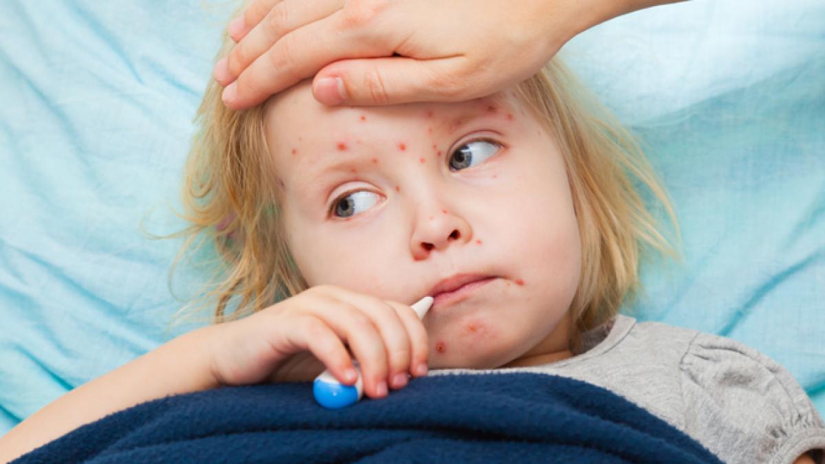 varicela_75951500
