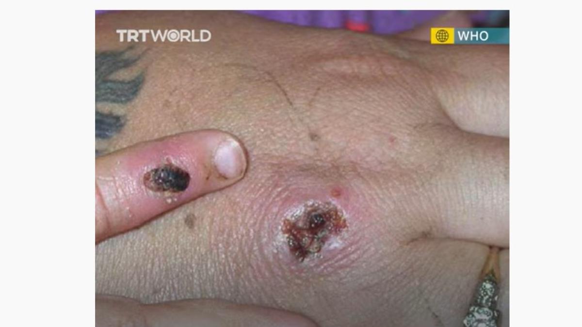 varicela-maimutei_97529300