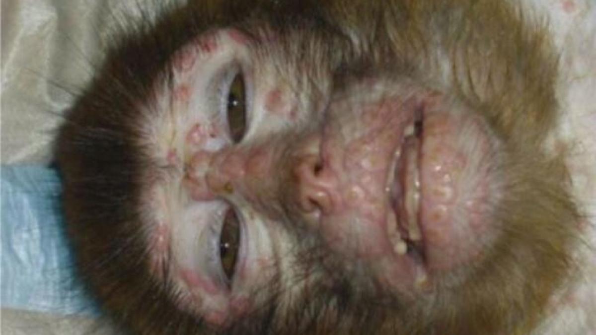 variola-maimutei_86547800