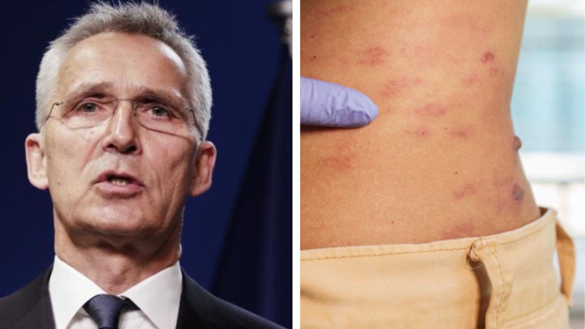 stoltenberg_zona_zoster_64435000