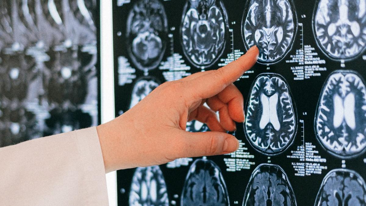 anorexia-poate-duce-la-schimbari-dramatice-in-creier_57103200