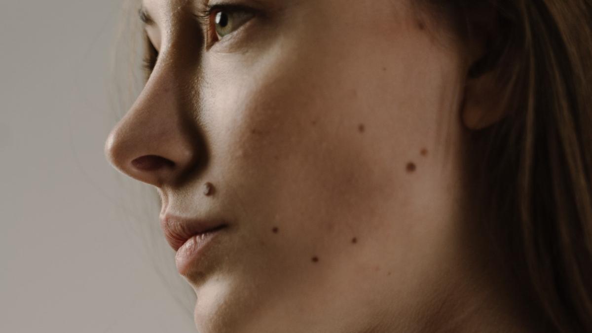 alunite-periculoase-pe-piele_01851300