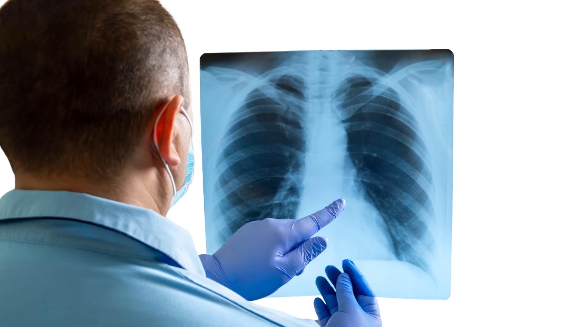 screening-cancer-pulmonar_25571500
