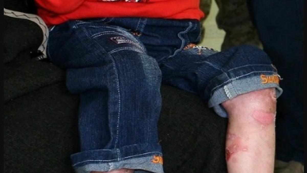 boala-copilului-fluture_75380600