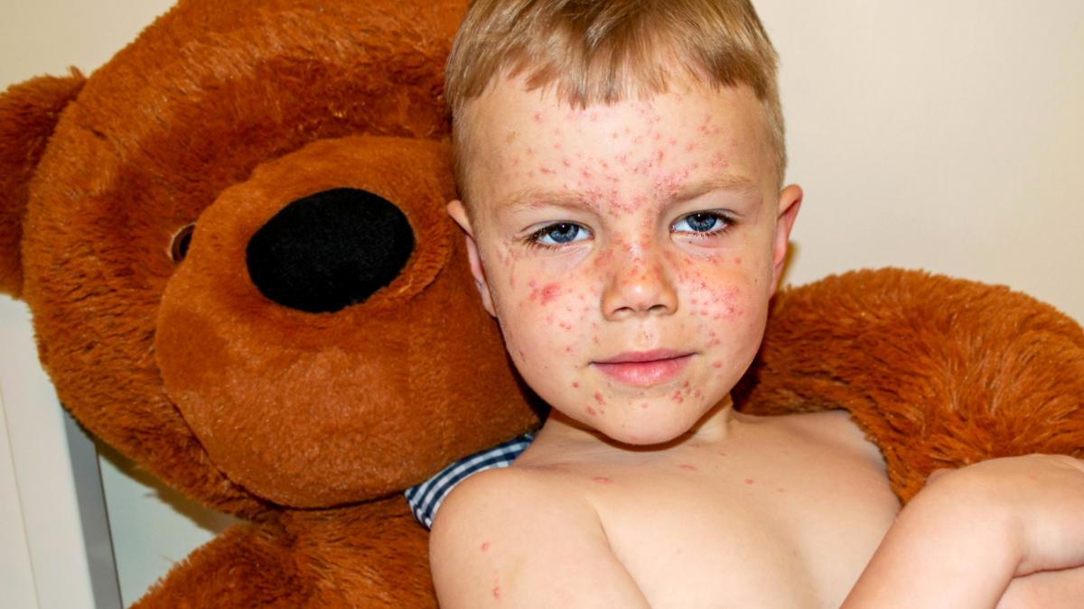 varicella-virus-chickenpox-bubble-rash-child_15048000