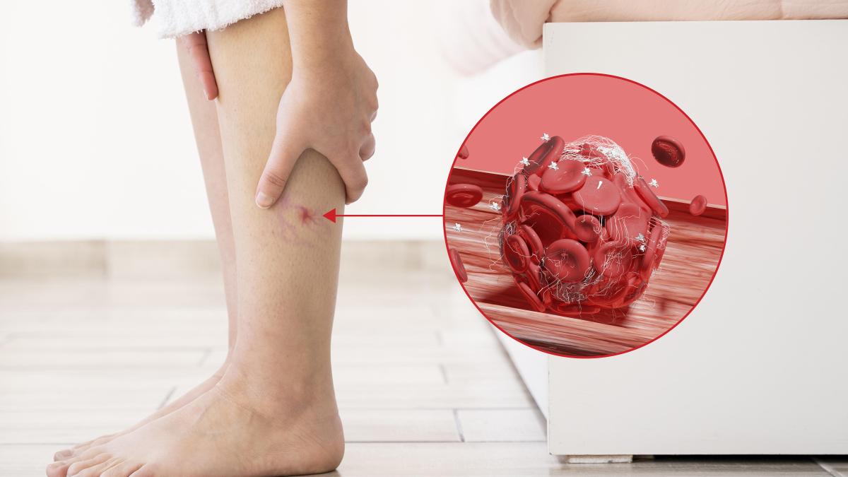cum-te-salvezi-de-tromboza-periferica--dr--munteanu-sanador-ideal-e-sa-vii-in-primele-24-48-de-ore--daca-nu-se-intervine--se-ajunge-la-amputatie_80998900