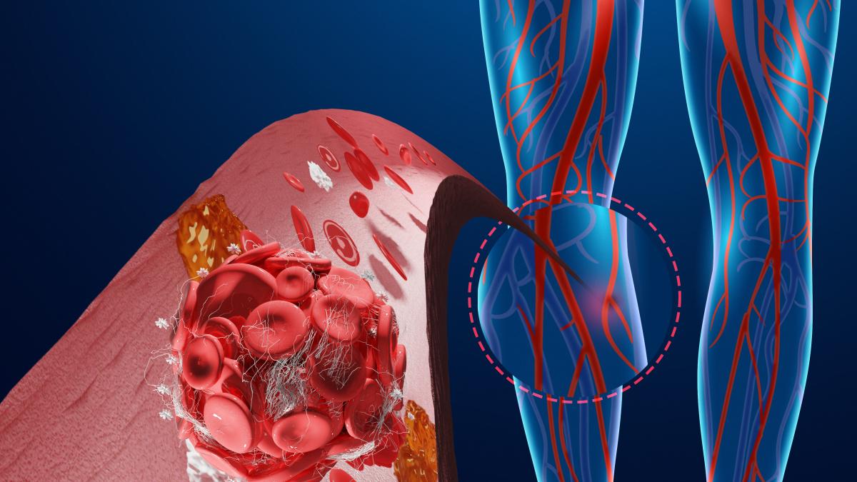 importanta-statinelor-in-arteroscleroza--dr--rodica-niculescu-sanador-intra-in-medicatia-clasica-si-obligatorie-pentru-acesti-pacienti-_30388600