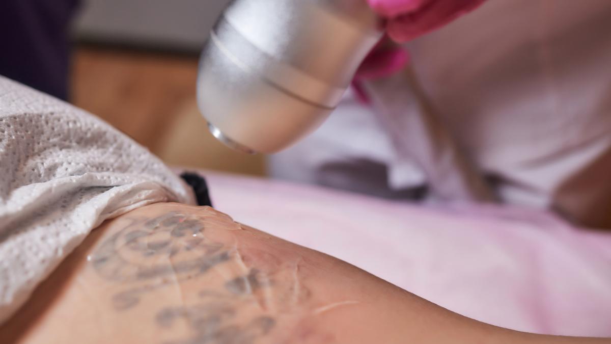 eliminare-tatuaj_03002300