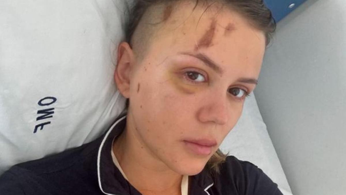 in-ce-stare-se-afla-emily-burghelea--a-suferit-prima-operatie-dupa-accident-simt-fierul-din-cap-cum-se-misca-1_85522300