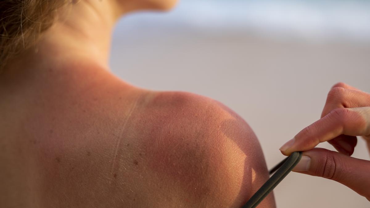 cum-se-trateaza-corect-arsura-solara--tipurile-de-piele-care-nu-se-ard-niciodata--dr--olga-simionescu--explicatii-importante_13595200