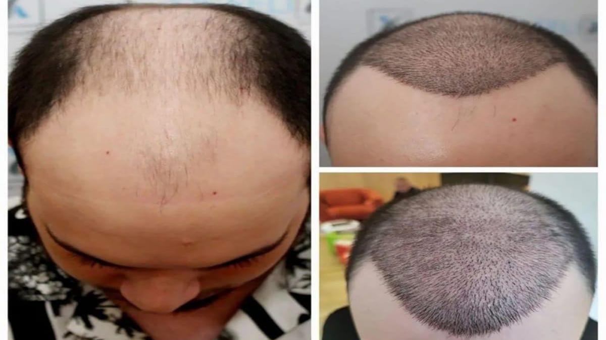 cauti-metode-de-a-scapa-de-chelie-vezi-aici-cat-costa-un-implant-de-par--despre-tehnica-q-fue_08264700