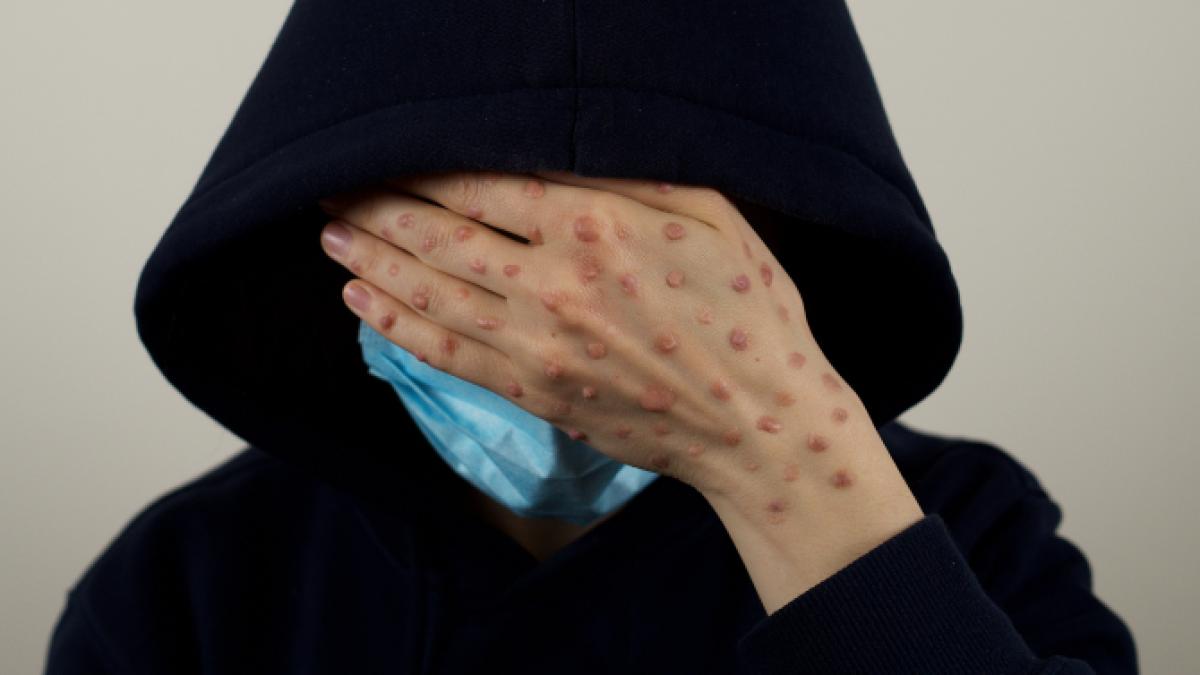 variola-maimutei-ingrijorare_94630300