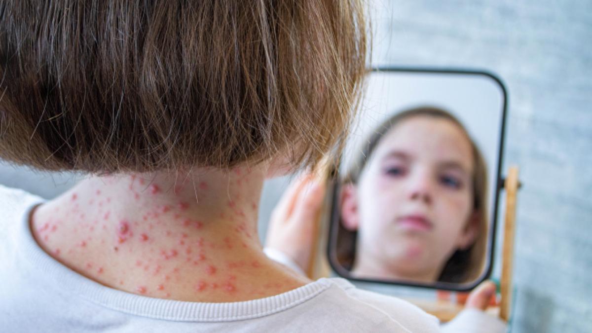 aproape-500-de-noi-cazuri-de-rujeola-in-ultima-saptamana--in-romania-1_93702600