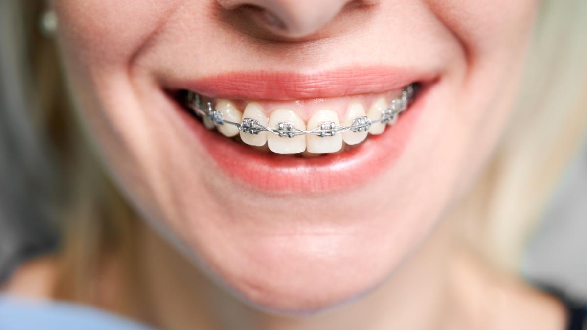 aparat-dentar-tipuri-beneficii-i-pre-uri-in-2025_94701100