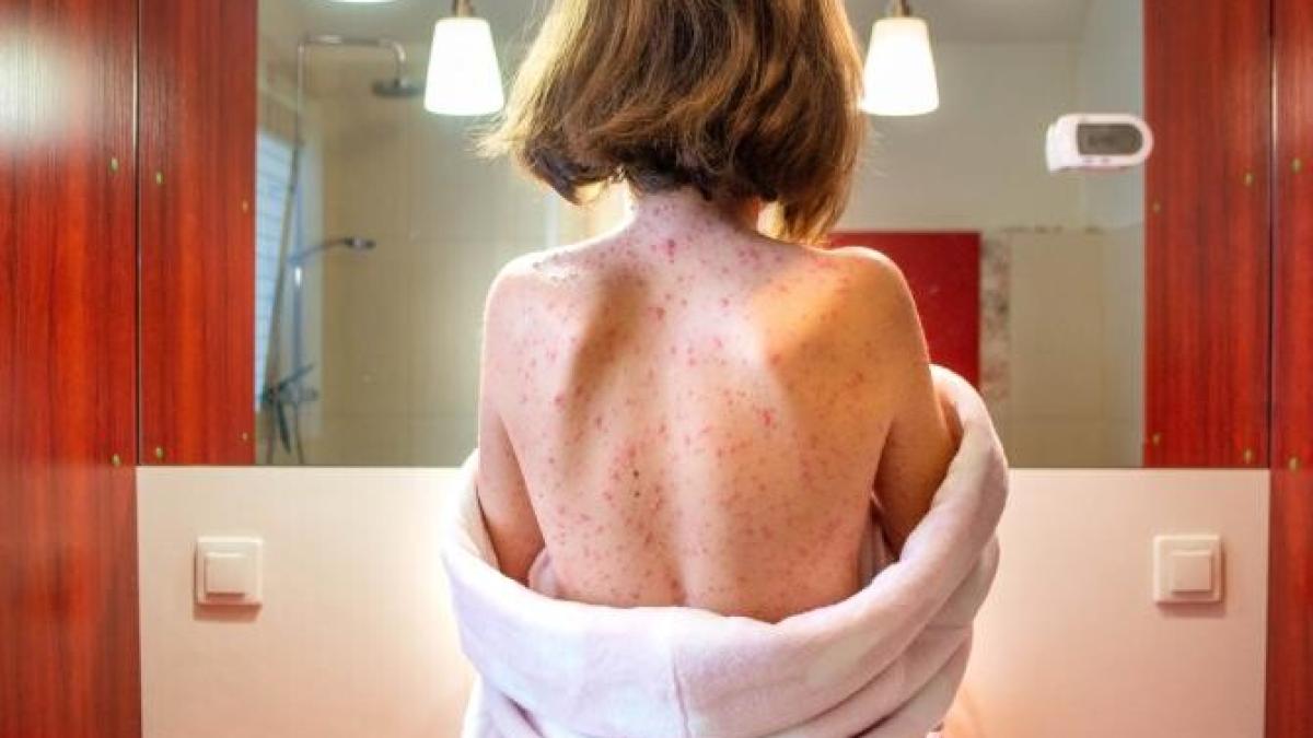 aproape-500-de-noi-cazuri-de-rujeola-in-ultima-saptamana--in-romania_86502600