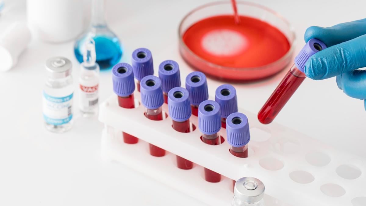 Analiza care arată dacă ai deficit de fier sideremie, feritină și fier seric. Par la fel, dar una îți spune adevărul