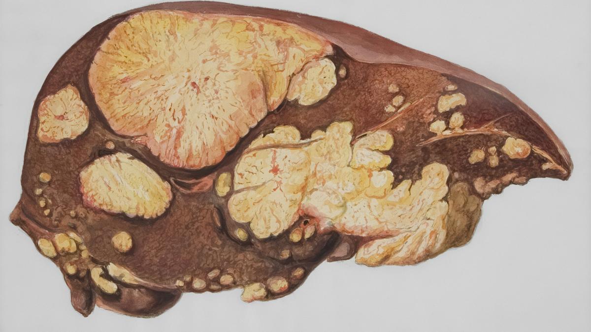 Ficat. Boala ficatului gras: ce trebuie să știi. Dr. Speranța Iacob, la DC Medical și DC News