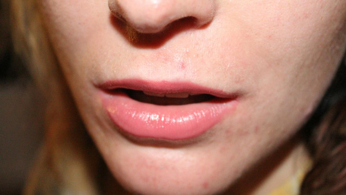 De ce e riscant să îți storci coșurile albe de pe față. Specialiștii avertizează: „Este o capcană”