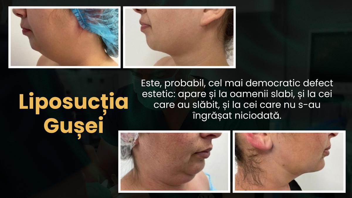 Liposucția de gușă de ce apare gușa inclusiv la oamenii slabi și cum se corectează (1)