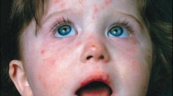 romania sub amenintarea unei epidemii de rujeola