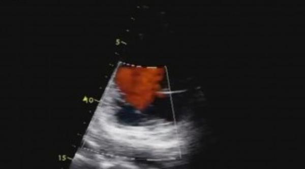 vezi cum arata inima unui dependent de heroina video