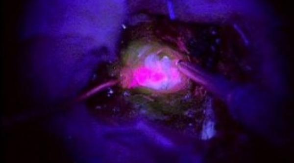 sprayul fluorescent care depisteza cancerul