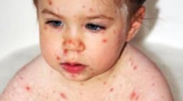 epidemie de rubeola peste 800 de copii s au imbolnavit