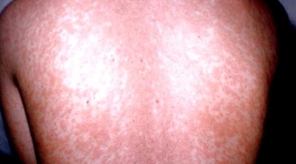 epidemie de rubeola zeci de cazuri au fost confirmate de medici