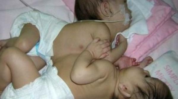 fetitele siameze de la pitesti au fost transportate la bucuresti