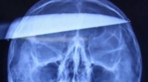 un barbat din iasi a stat peste 6 ani cu o lama de 12 cm in cap