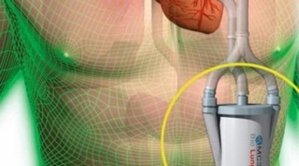 plamanul artificial folosit in tratarea insuficientei respiratorii o premiera in romania