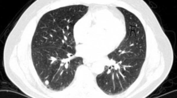 rezultate uimitoare pentru radiologi la un test cu gorila care danseaza