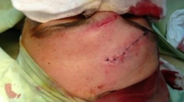 imagine socanta cu raul rusescu taiat pe frunte cu crampoanele