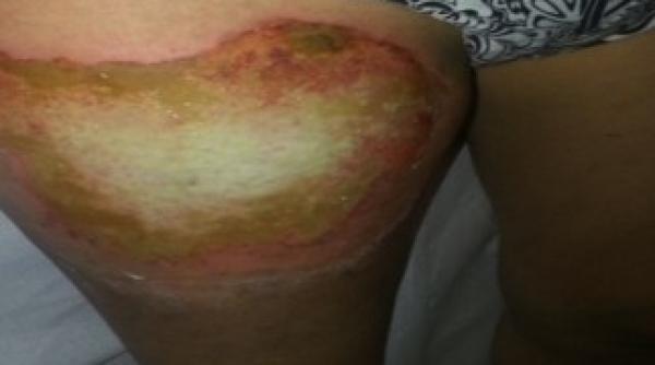 cum arata rana fetei a carei telefon e explodat in buzunar