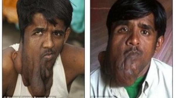 un indian cu o tumora faciala uriasa a fost operat foto