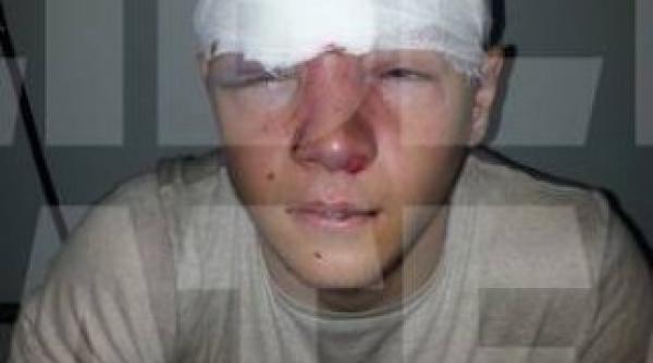 fotbalist de la steaua snopit bataie este desfigurat foto socant