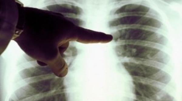 antioxidantii favorizeaza aparitia cancerului vezi explica