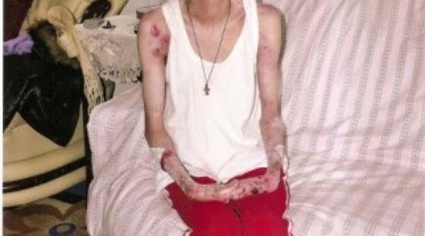 drama prin care trece o romanca sufera de o boala care ii macina pielea si oasele