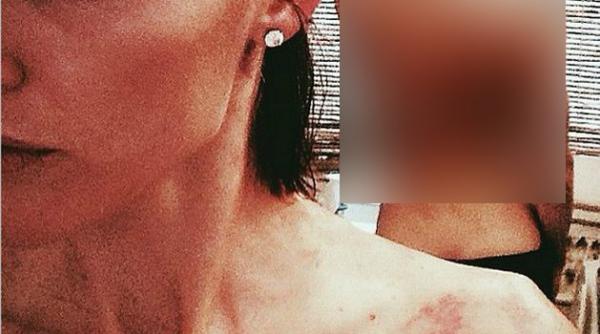 ingrozitor cum arata spatele acestui model dupa un tratament pentru dureri