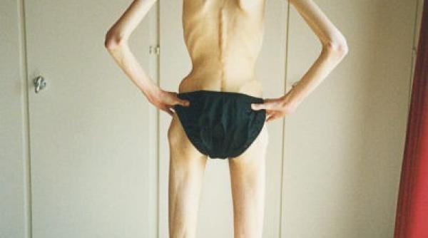 poveste traumatizanta anorexia este singura mea prietena