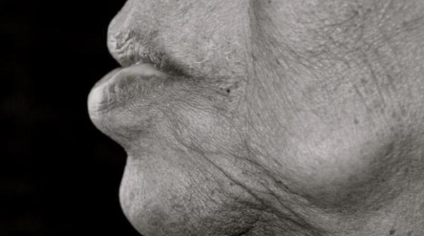 fragilitatea un nou sindrom in aten ia medicilor din europa